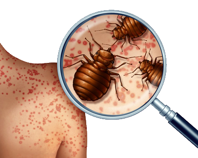 Bedbug Bites