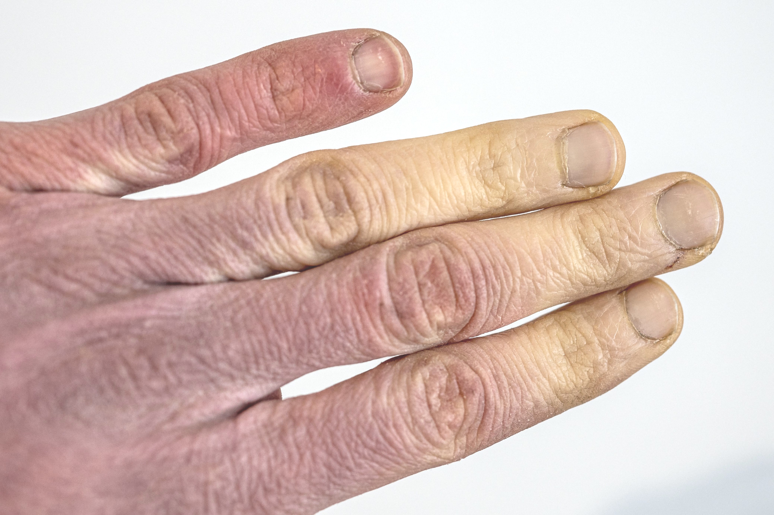 what is white finger vibration Understanding Vibration White Finger Symptoms main image 1